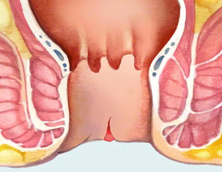 Home fissure